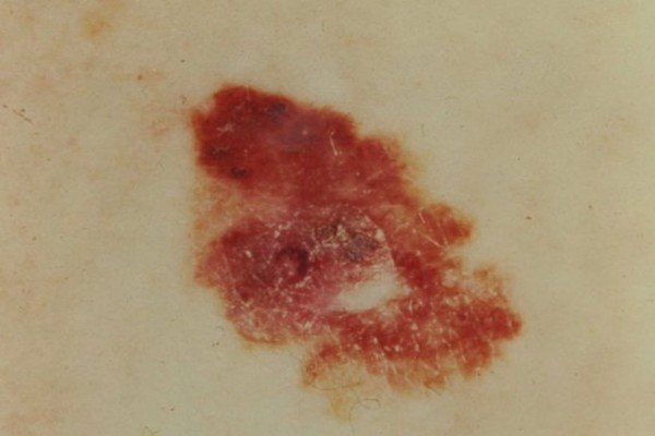 10 Deadly Signs Of Skin Cancer You Need To Spot Early Page 8 Topmannews