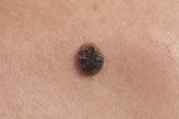 10 Deadly Signs Of Skin Cancer You Need To Spot Early Page 6 Topmannews